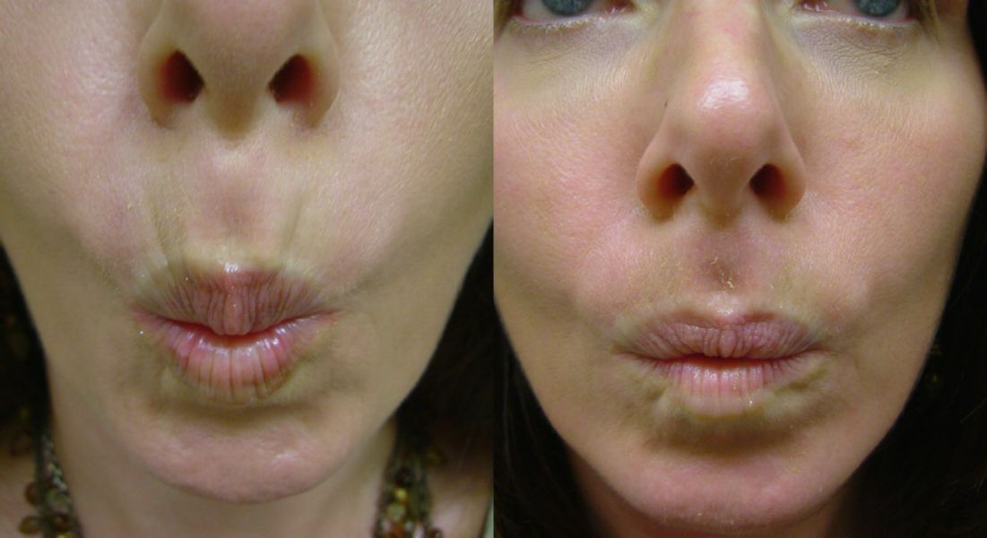 botox lip lines before and after