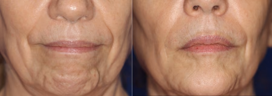 botox chin before and after