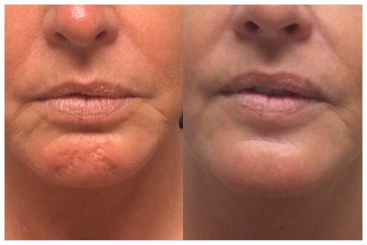 botox chin before and after