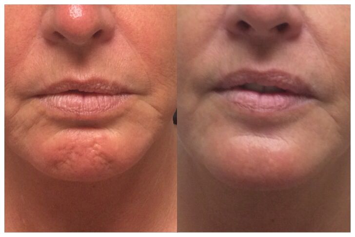 botox chin before and after