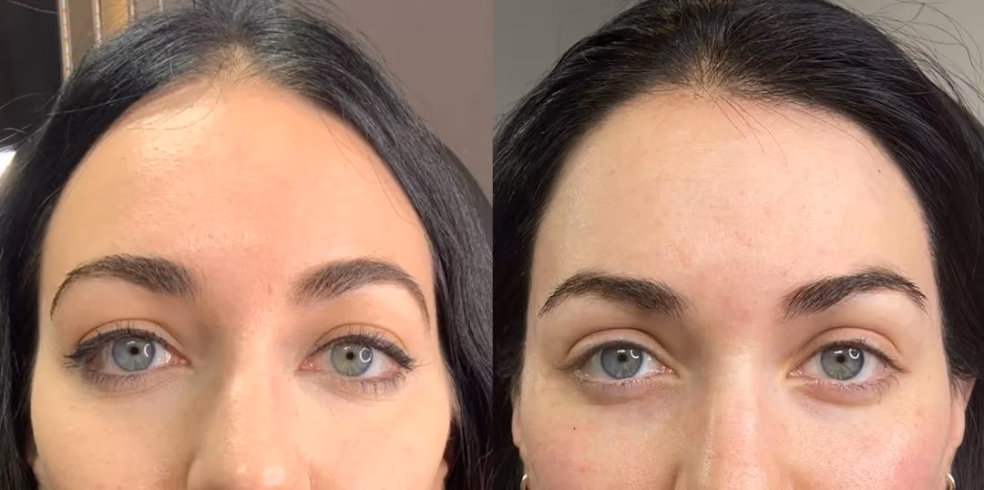 temple dermal filler before and after