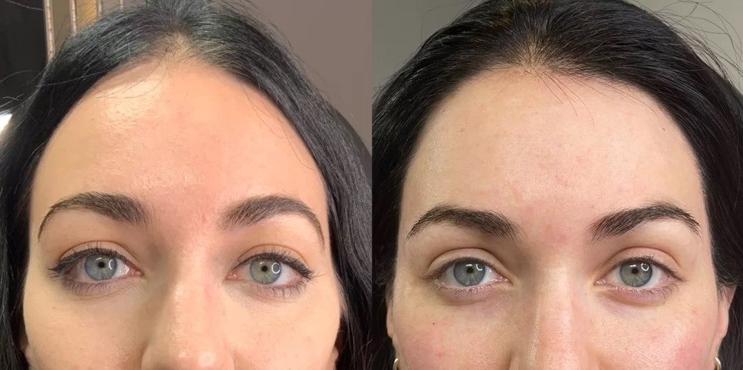 temple dermal filler before and after