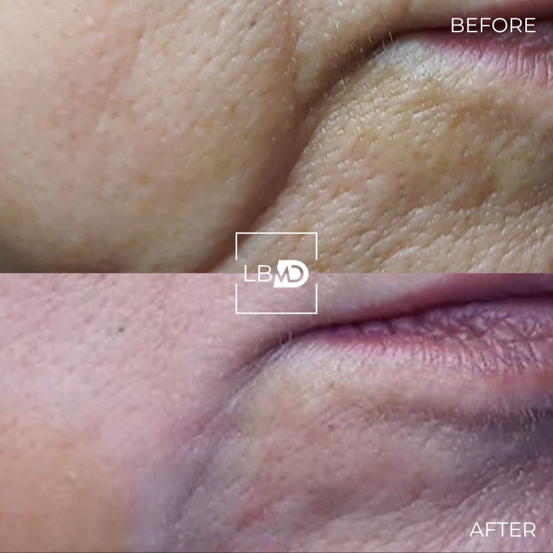 dermal filler marionette lines before and after