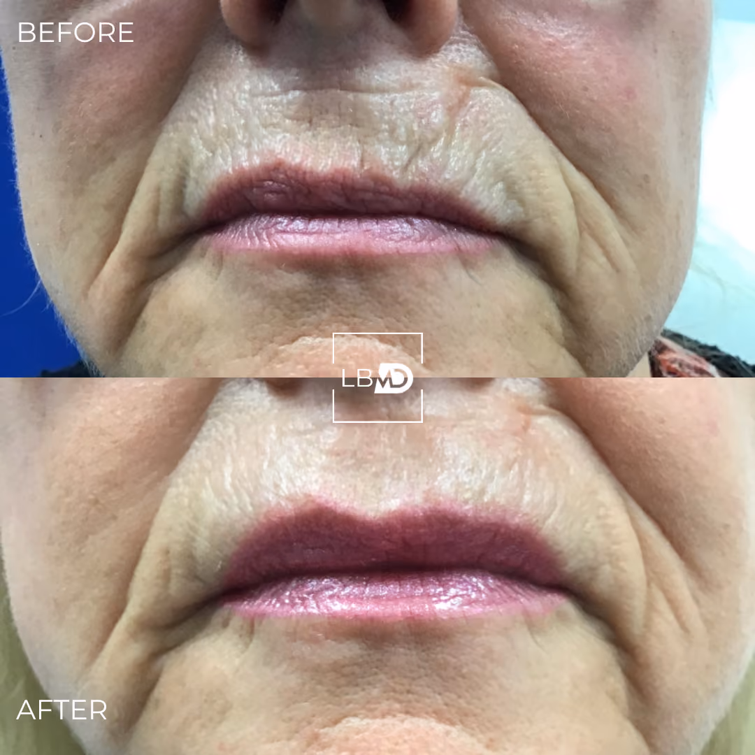 marionette lines dermal filler before and after
