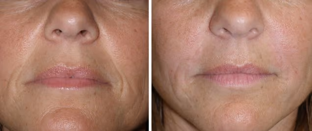 nasolabial folds dermal filler before and after
