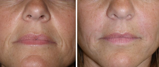 nasolabial folds dermal filler before and after