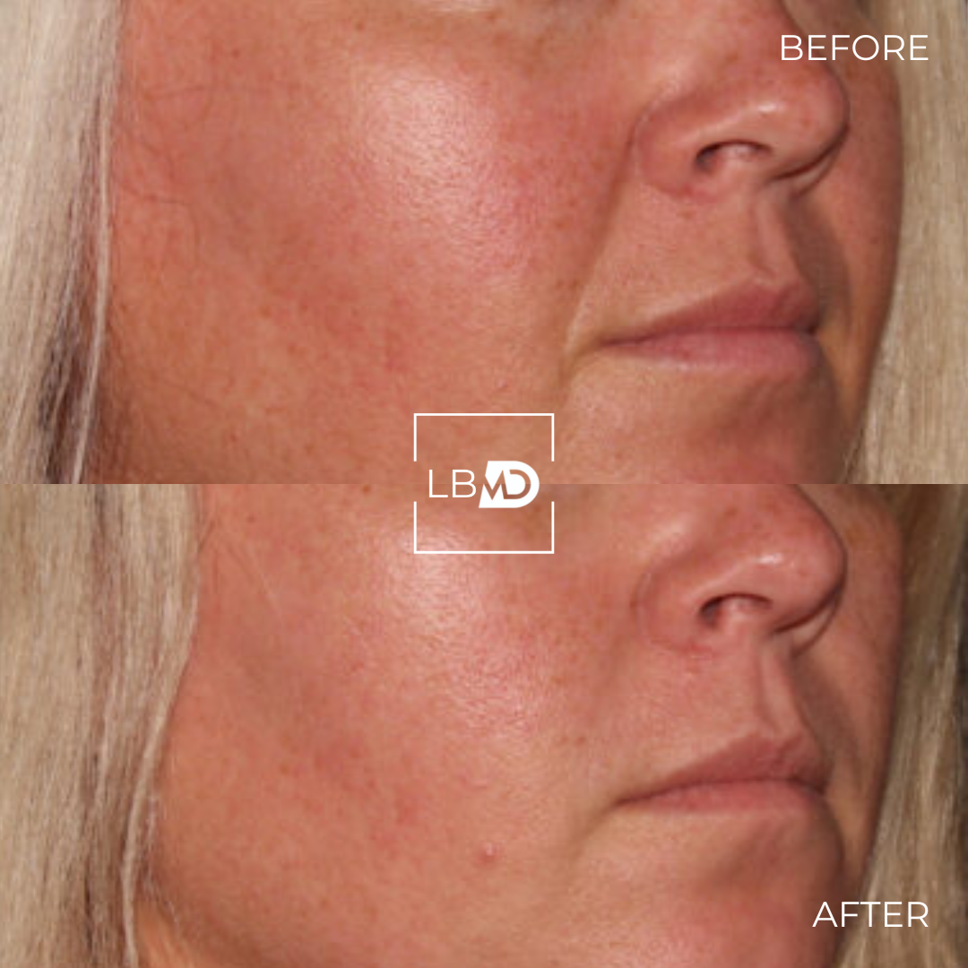 nasolabial folds dermal filler before and after