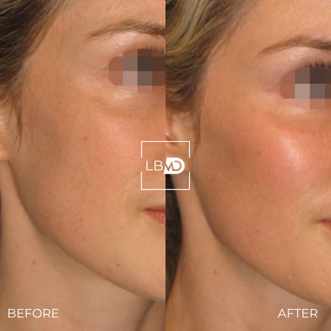 cheek dermal filler before and after