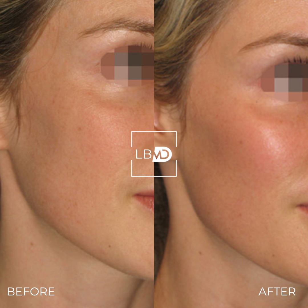 cheek dermal filler before and after