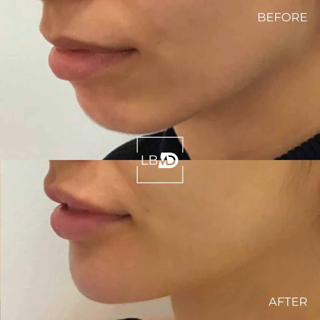 chin dermal filler before and after