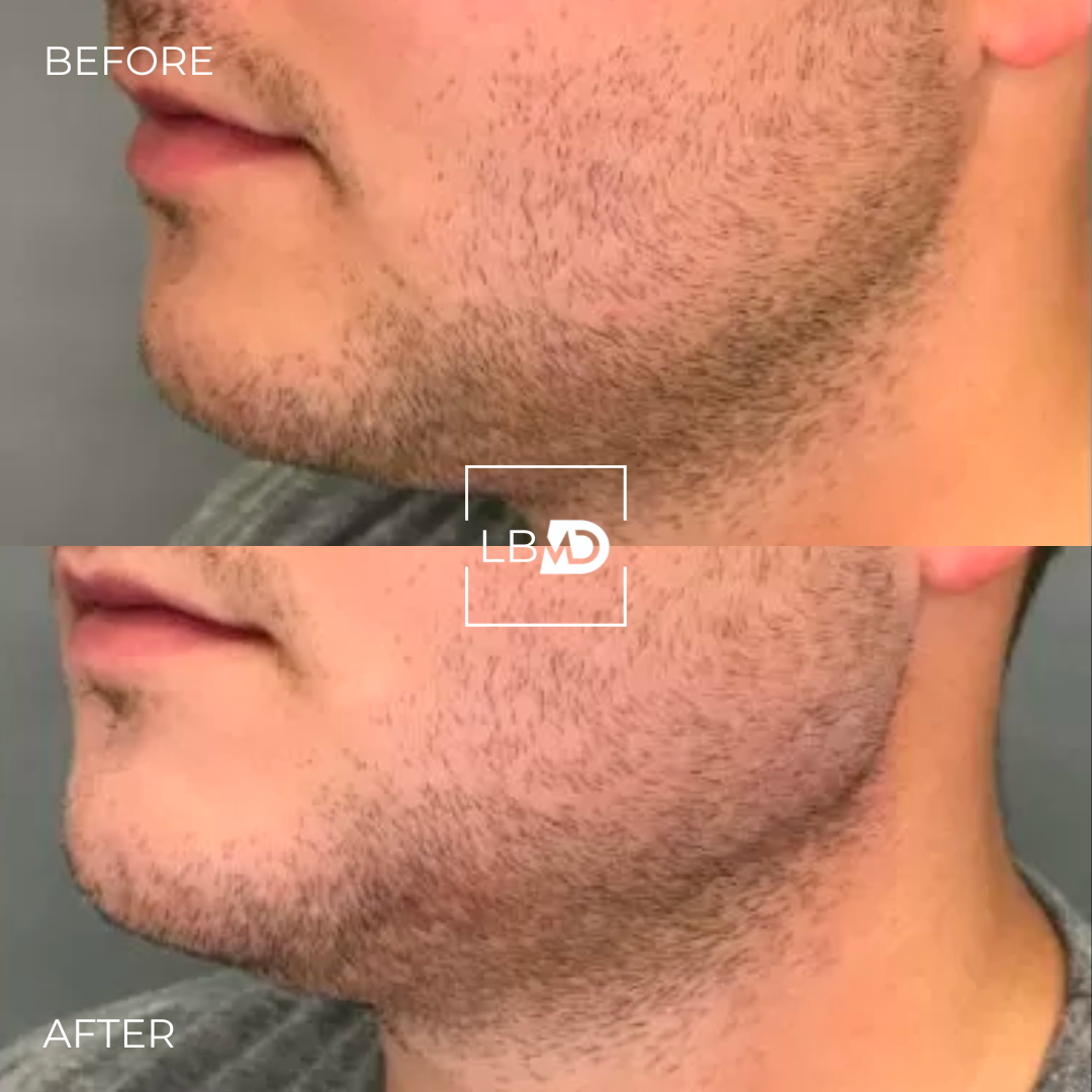 chin dermal filler before and after