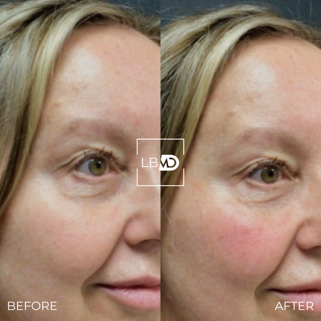 under eye dermal filler before and after