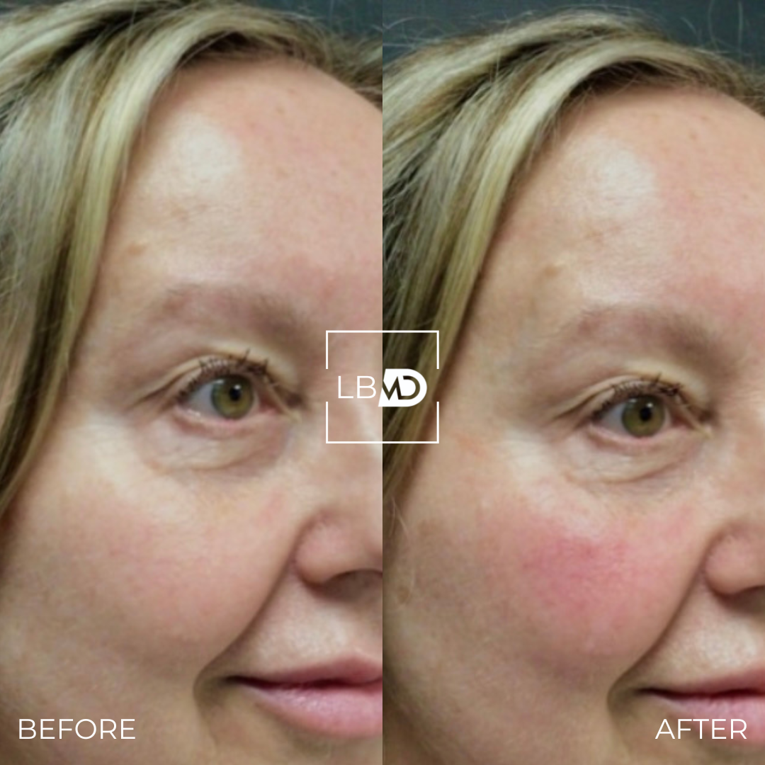under eye dermal filler before and after