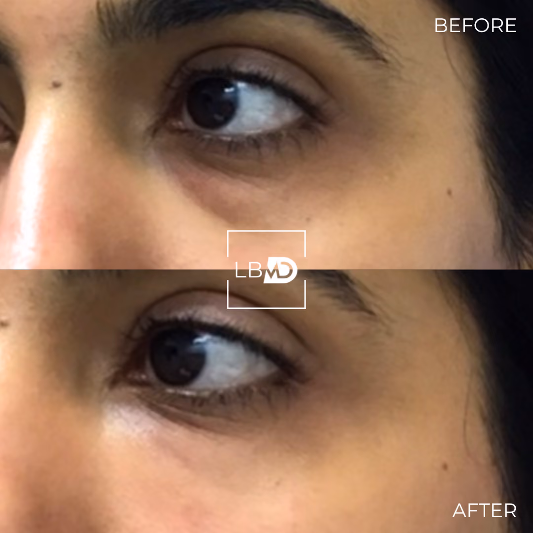 under eye dermal filler before and after
