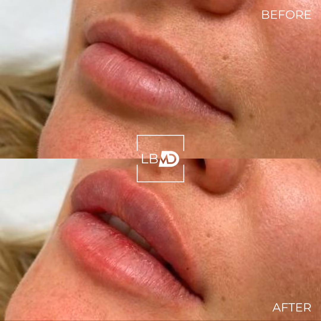 lip dermal filler before and after