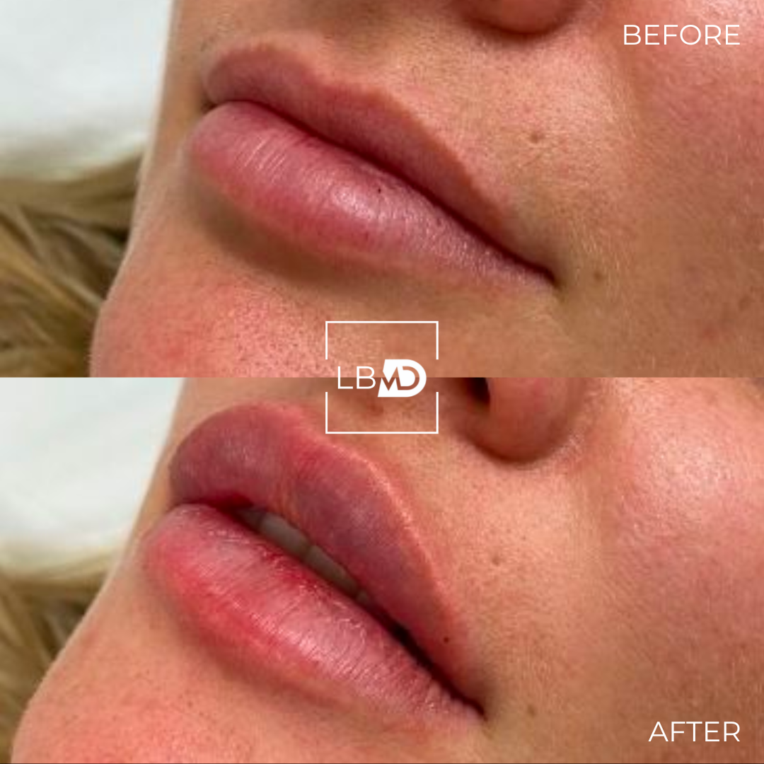 lip dermal filler before and after