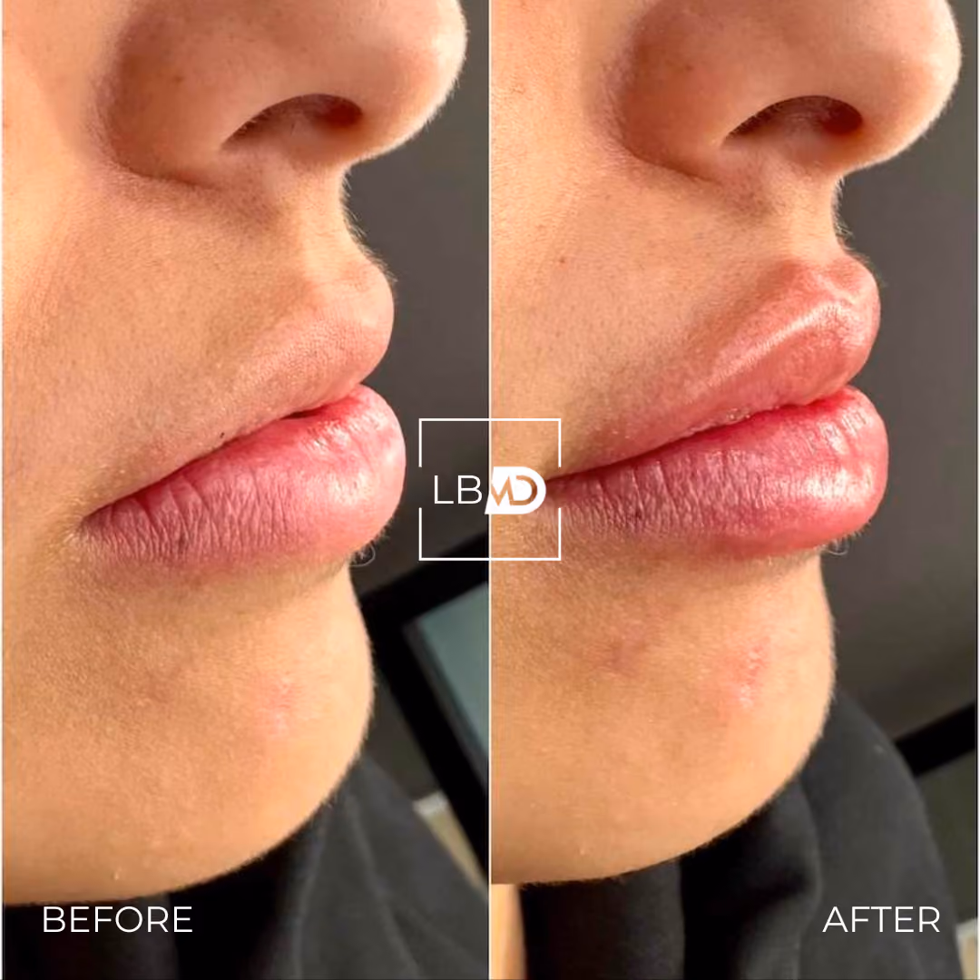 lip dermal filler before and after