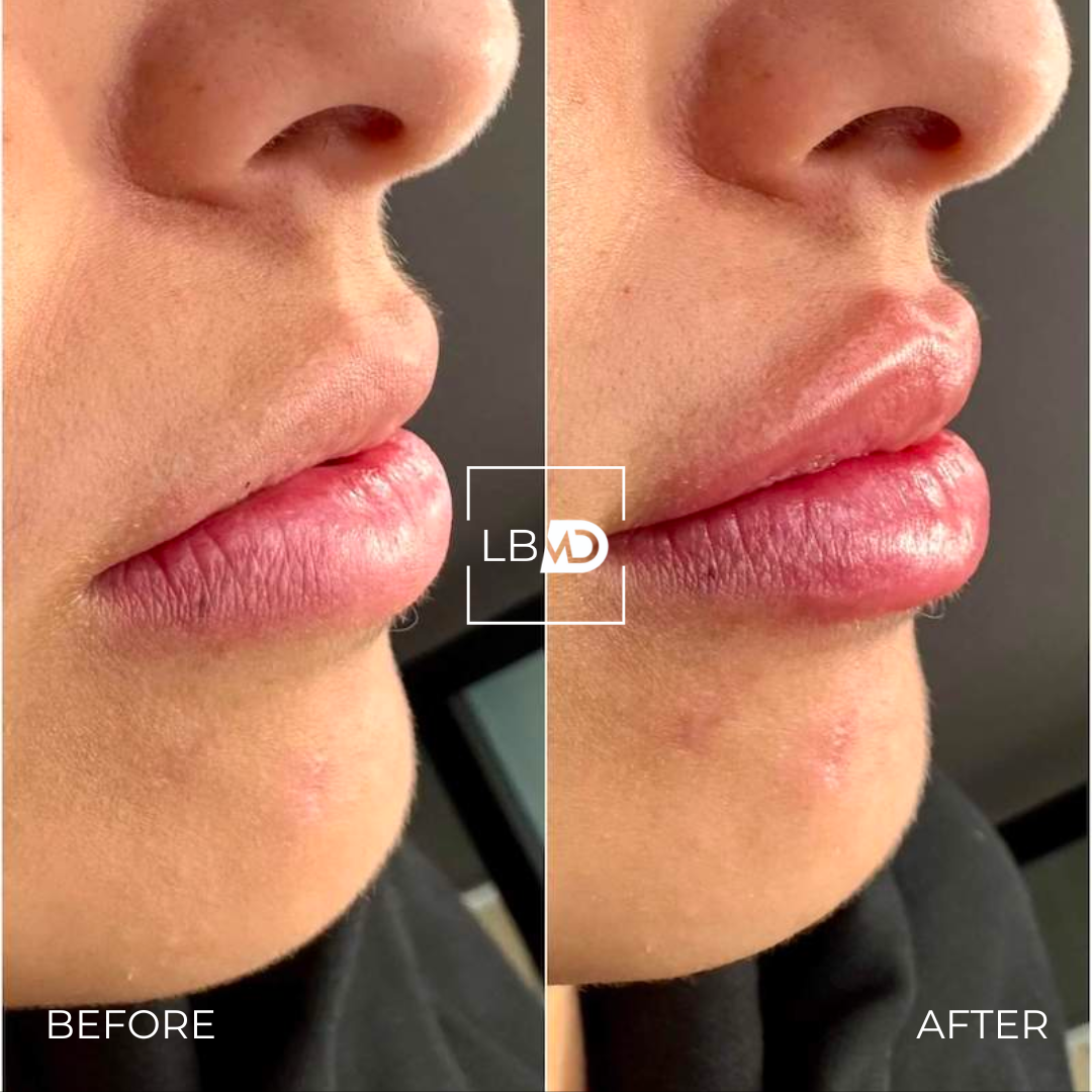 lip dermal filler before and after