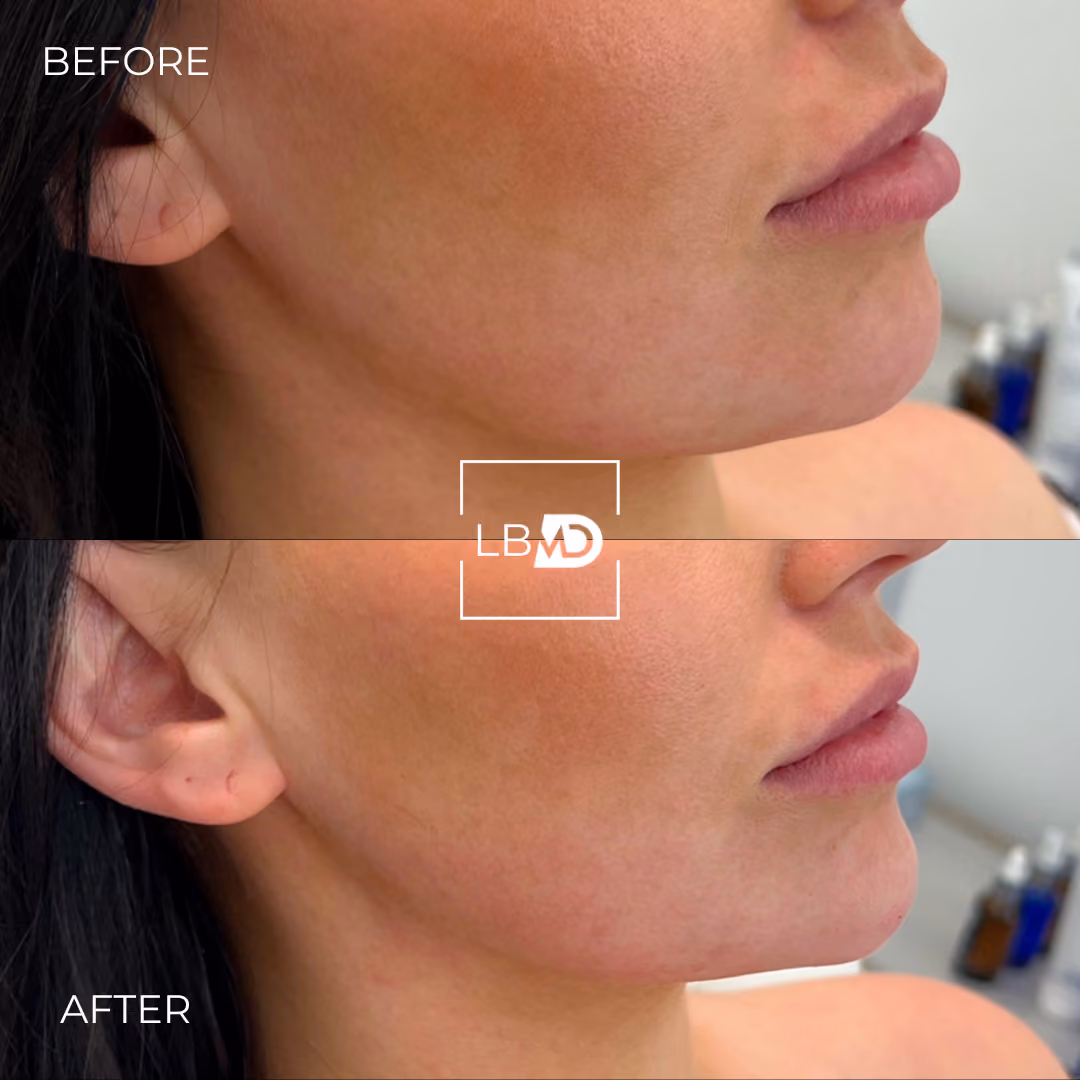 jawline dermal filler before and after