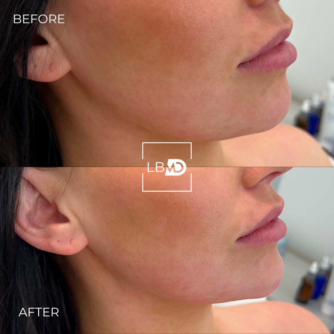 jawline dermal filler before and after
