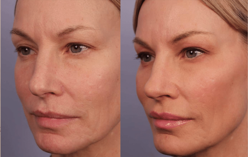 morpheus8 face before and after