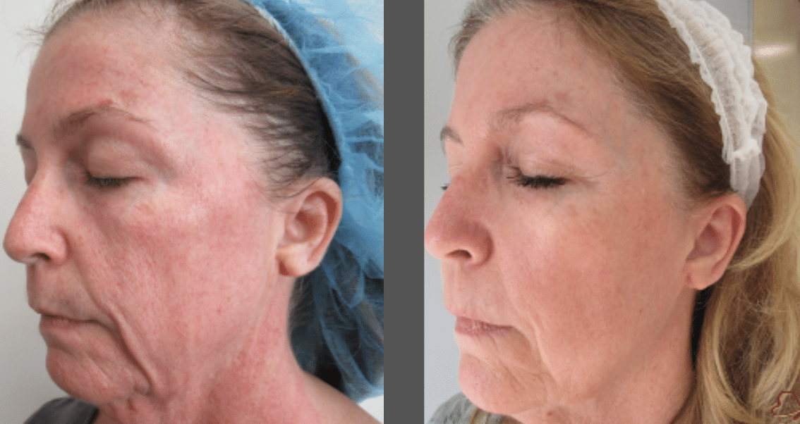 morpheus8 face before and after