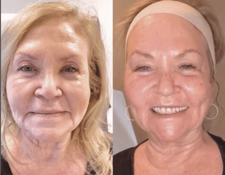 morpheus8 face before and after