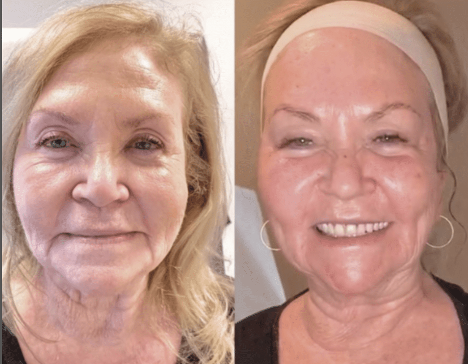 morpheus8 face before and after