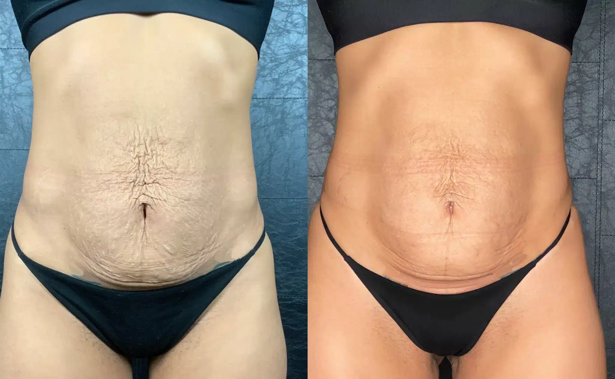 morpheus8 body before and after