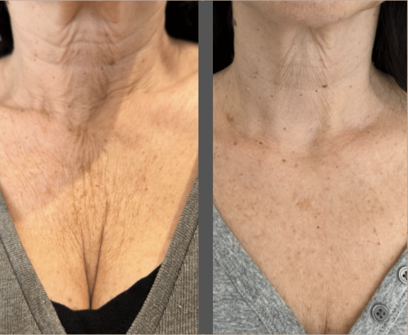 body morpheus8 before and after