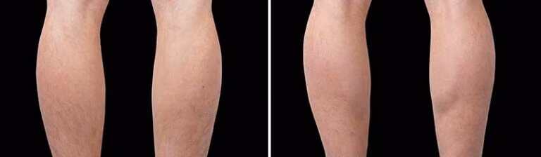 calves emsculpt before and after