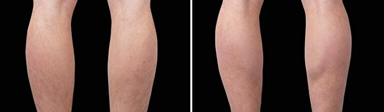 calves emsculpt before and after