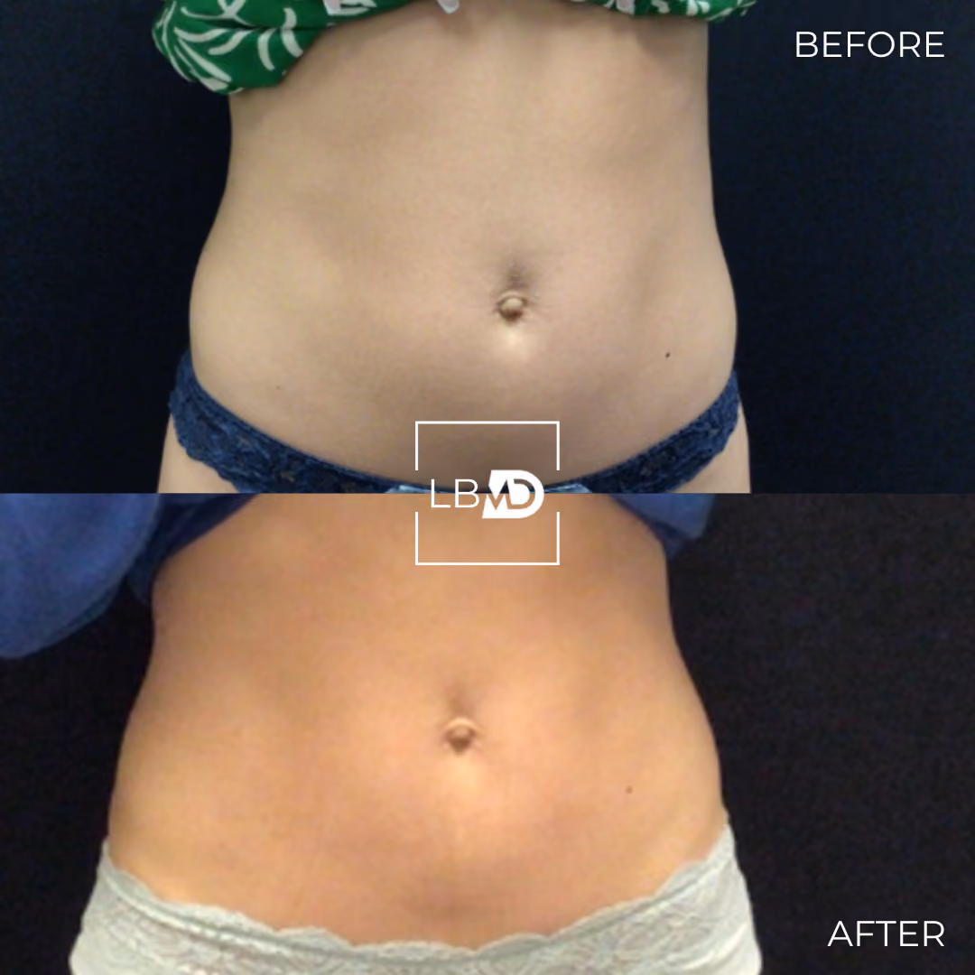 abs emsculpt before and after