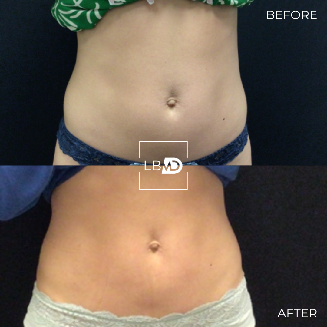 abs emsculpt before and after