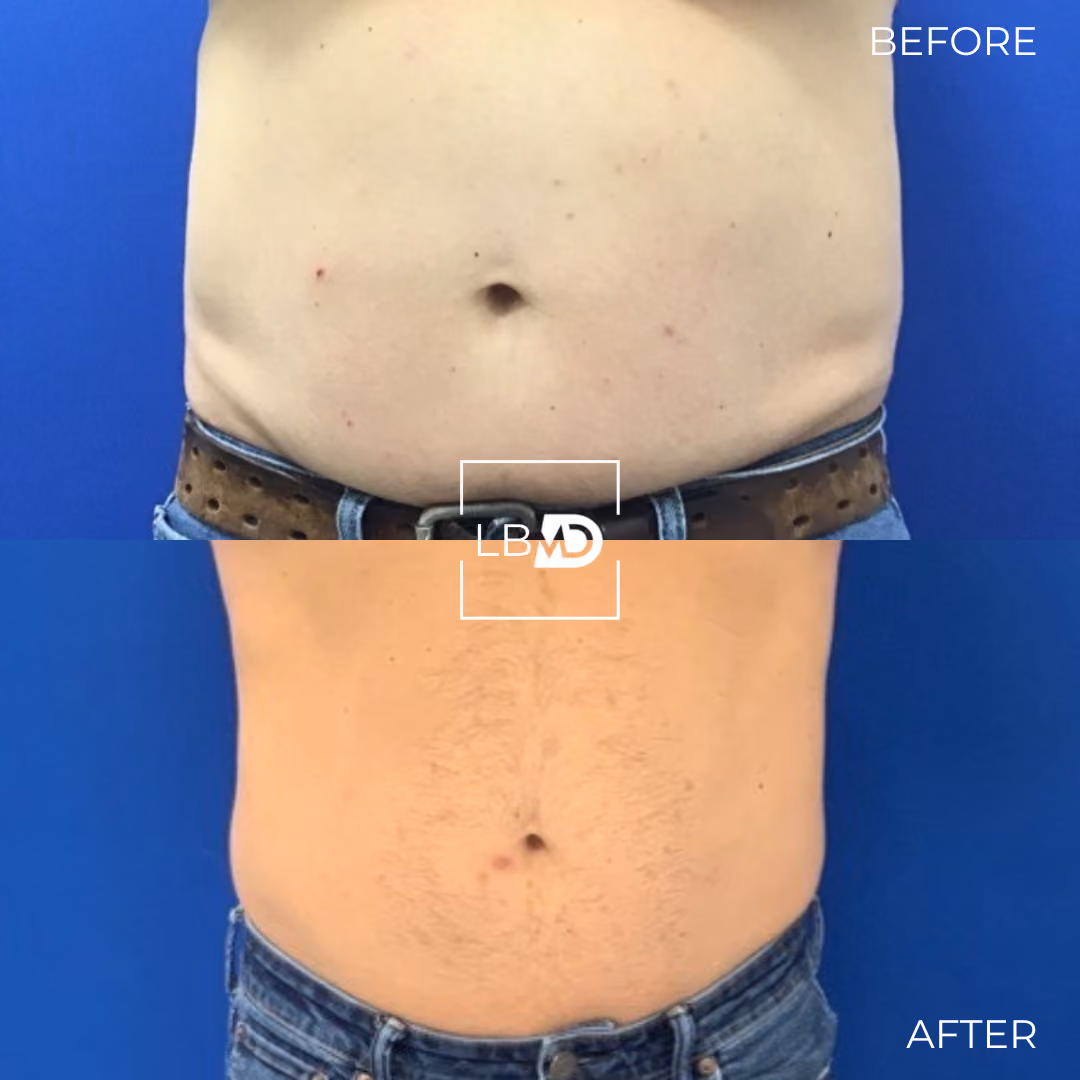 abs emsculpt before and after