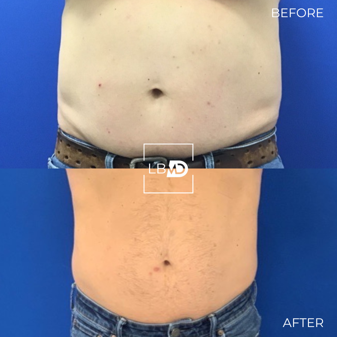 abs emsculpt before and after