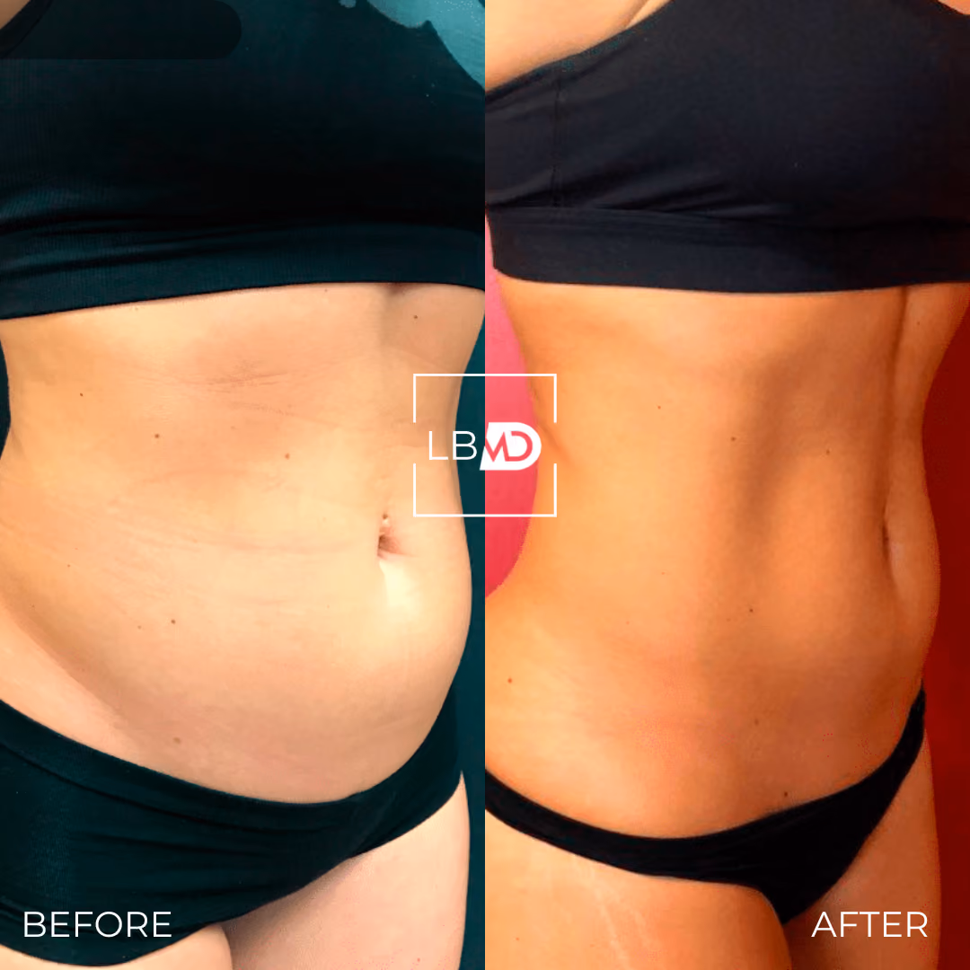 abs emsculpt before and after