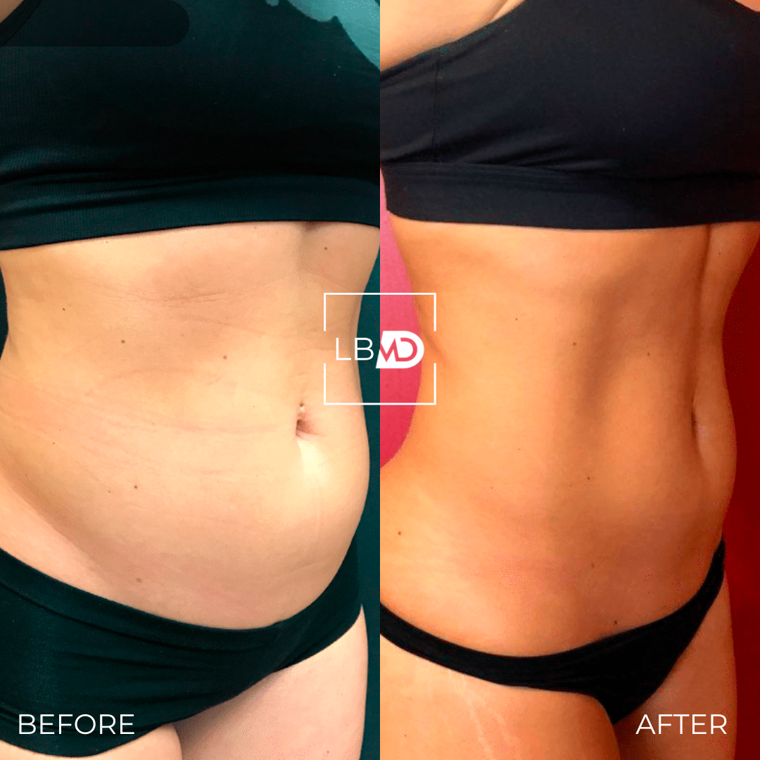 abs emsculpt before and after