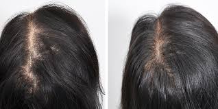hair transplant for women before and after