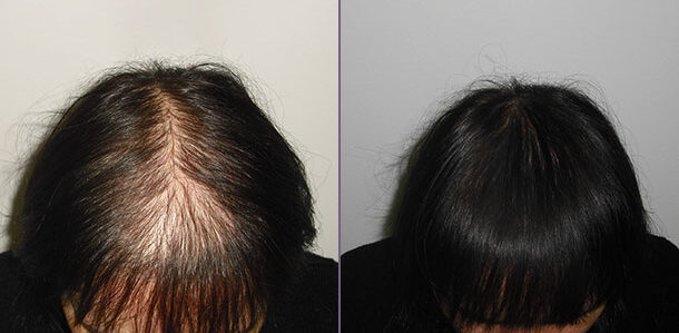 hair transplant for women before and after