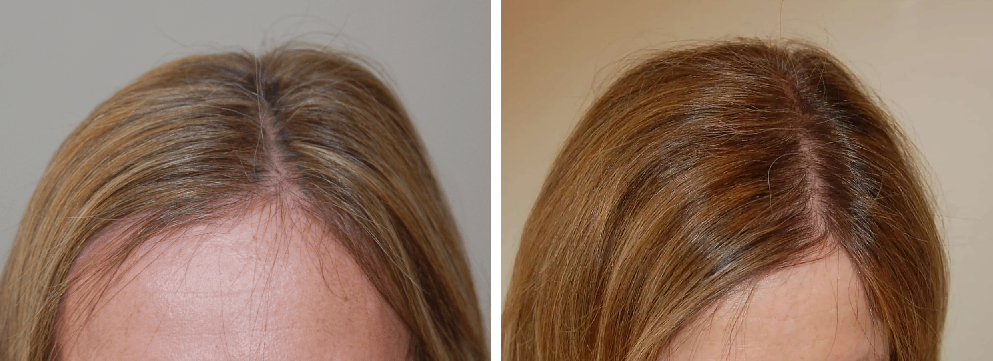 hair transplant for women before and after