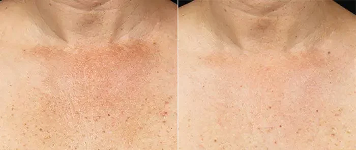 fraxel before and after