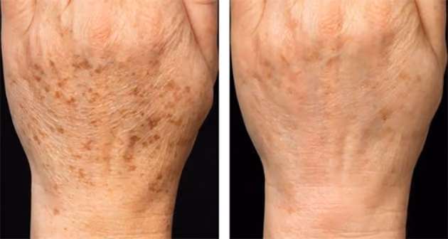 fraxel before and after