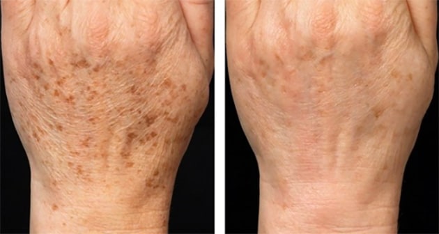 fraxel before and after