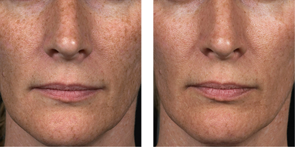 fraxel before and after