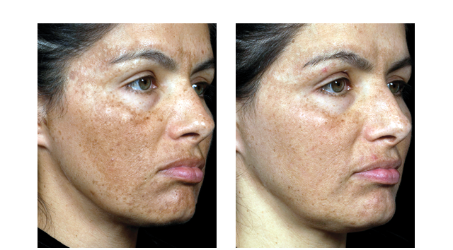 fraxel before and after
