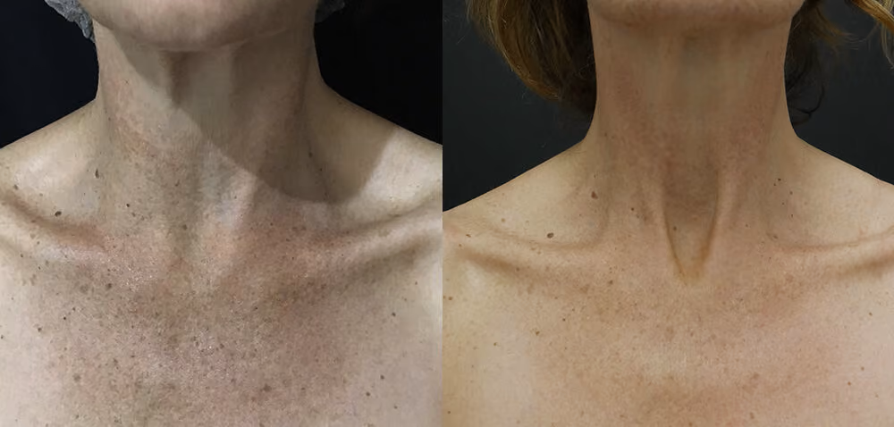 fraxel before and after