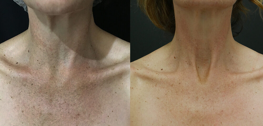 fraxel before and after