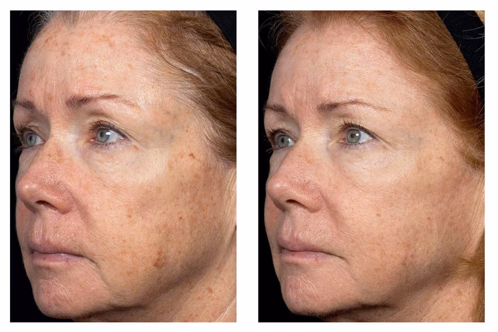 fraxel before and after