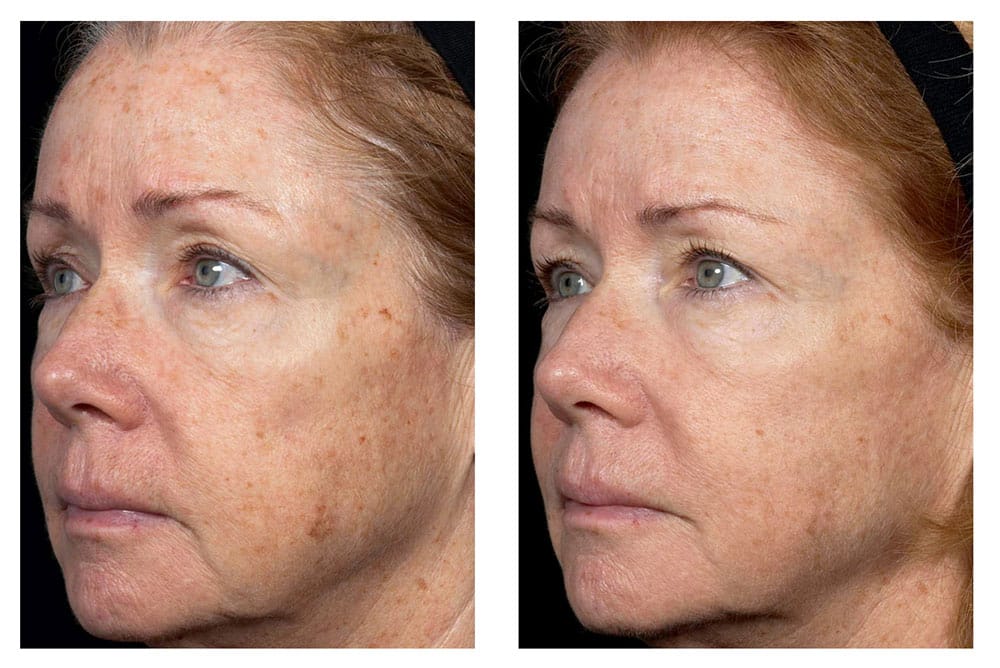 fraxel before and after